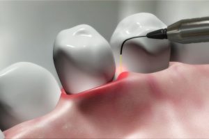 Benefits of Laser Technology for Cosmetic Dentistry