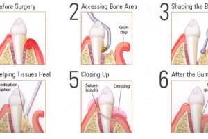 Fighting Gum Disease: How to Keep Your Teeth