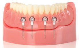 Mini Dental Implants: Life-Changing Options For Denture Patients